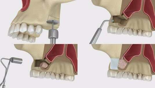 带侧向通道的鼻窦提升手术。牙科手术的3D高清在线视频素材下载