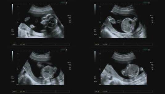 胎儿超声波影像高清在线视频素材下载
