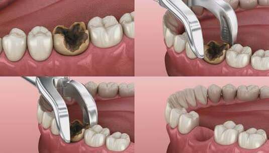 龋齿损伤磨牙的拔除。高清在线视频素材下载