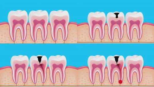 牙齿内部结构图，显示蛀牙侵蚀情况高清在线视频素材下载