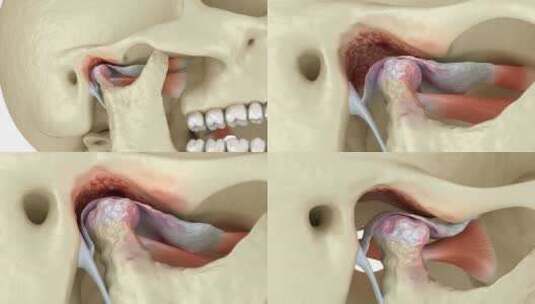 颞下颌关节关节炎和关节盘脱位。牙科3D动高清在线视频素材下载