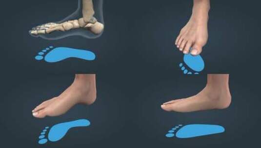 足部骨骼扁平足跟骨趾骨跖骨骨科足部畸形高清在线视频素材下载