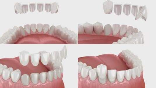 牙齿贴面放置程序。牙科3D动画高清在线视频素材下载