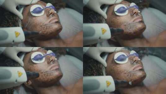 激光设备美容师治疗皮肤的特写面部剥离程序高清在线视频素材下载