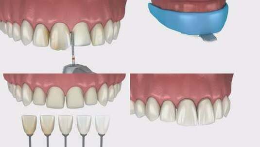 贴面-牙齿贴面的准备、模型、颜色选择和放高清在线视频素材下载