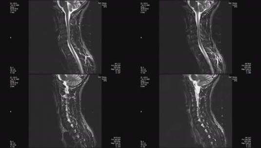 MRI扫描腰椎高清在线视频素材下载