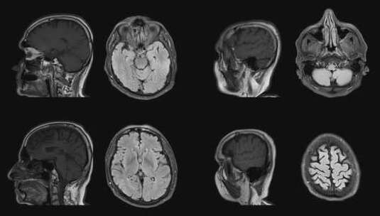 核磁共振脑部CT扫描MIR高清在线视频素材下载