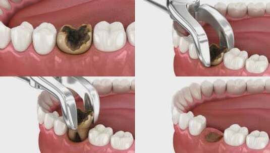受损牙齿的提取。牙科3D动画高清在线视频素材下载