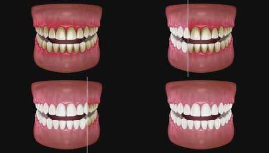清洁前后牙齿美白。牙科3D动画高清在线视频素材下载