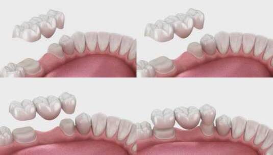 牙桥放置。3D动画高清在线视频素材下载