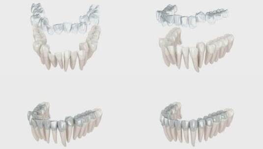 隐适美牙套或隐形保持器进行咬合矫正。3D高清在线视频素材下载