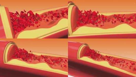 血细胞被斑块堆积堵塞的动脉胆固醇风险3D高清在线视频素材下载
