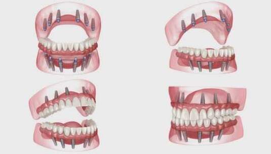 由6个植入物支持的假体。牙科3D动画高清在线视频素材下载