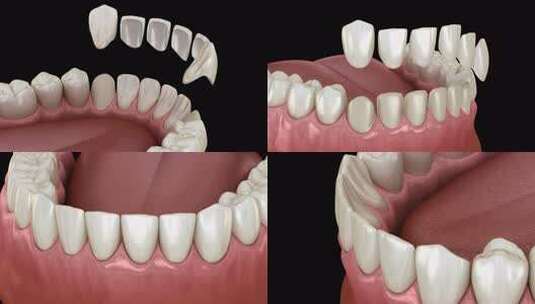中切牙和侧切牙贴面安装程序高清在线视频素材下载