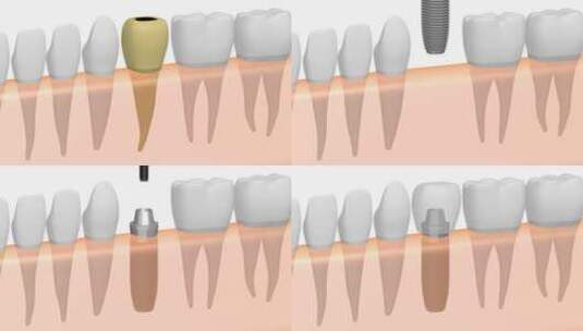 医院植牙高清在线视频素材下载