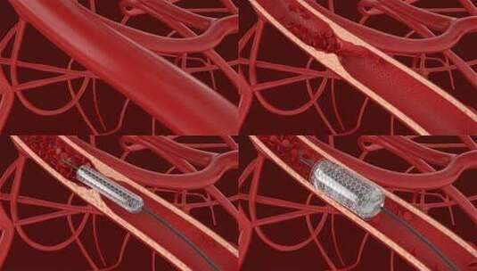 血管支架血管堵塞血栓高清在线视频素材下载