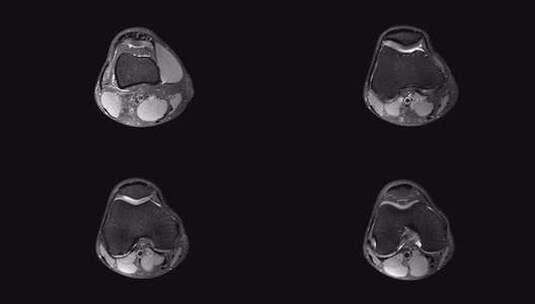 MRI膝关节或磁共振成像检测撕裂或扭伤高清在线视频素材下载