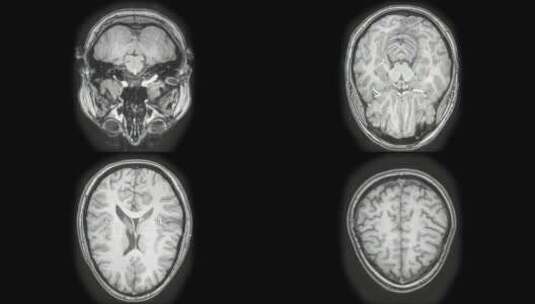大脑CT扫描高清在线视频素材下载