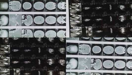 CT胶片影像高清在线视频素材下载