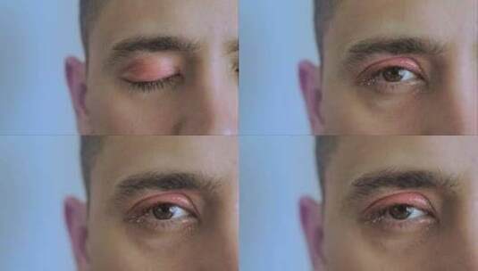 一个人因眼睛感染、结膜炎而红眼的特写镜头高清在线视频素材下载