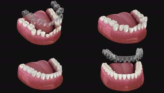 隐形矫正牙套牙齿矫正高清在线视频素材下载