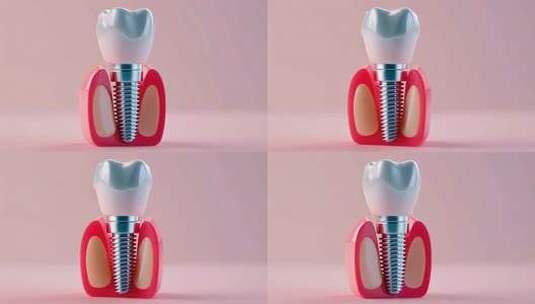 种植牙模型特写高清在线视频素材下载