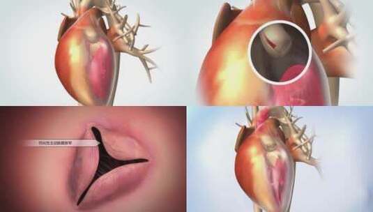 经导管心脏主动脉瓣置入术高清在线视频素材下载