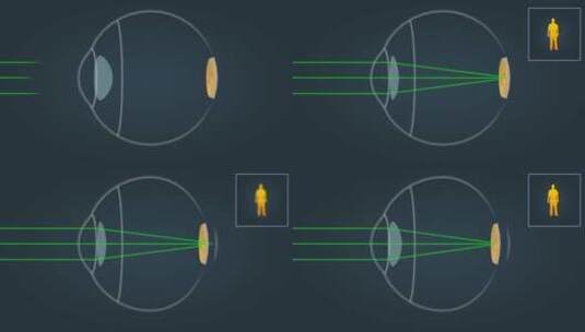 视力矫正眼睛近视高清在线视频素材下载