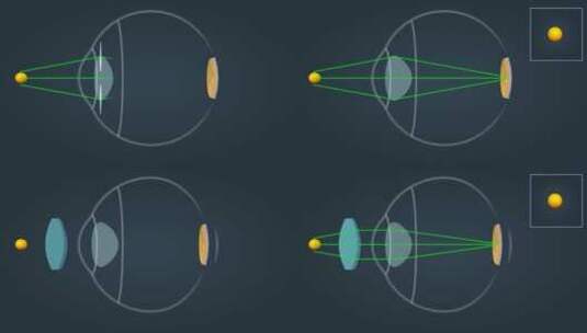 视力矫正眼睛近视高清在线视频素材下载