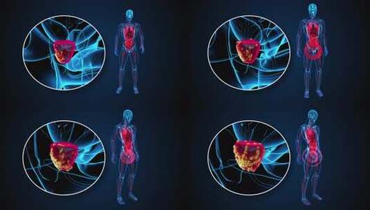 4K前列腺癌的抽象3D动画高清在线视频素材下载