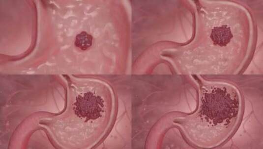 癌细胞在胃部扩散产生病变高清在线视频素材下载