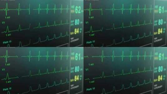 医院剧院的心率监测仪。医院的医疗生命体征高清在线视频素材下载