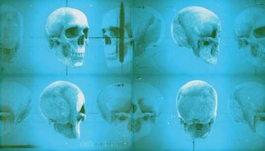 病历头骨06高清在线视频素材下载