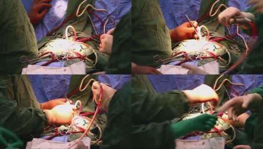 心脏手术高清在线视频素材下载