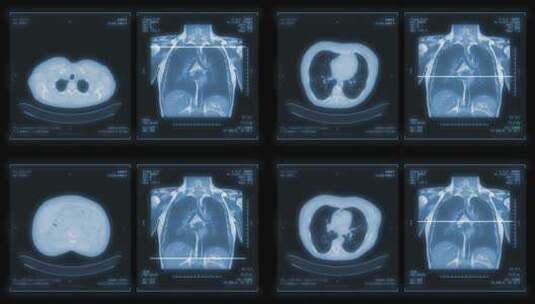 胸部肺部CT扫描MIP视图！高清在线视频素材下载