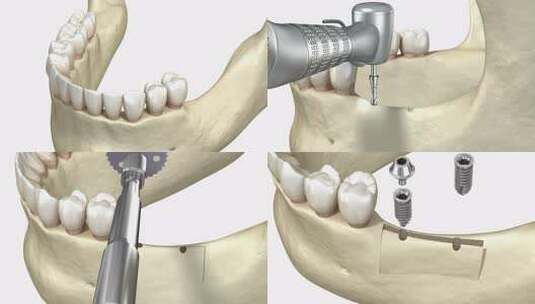 牙槽嵴的切割，隆起，植入。牙科手术，3D高清在线视频素材下载