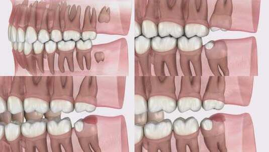 智齿和牙龈炎症。医学上准确的牙齿3D动画高清在线视频素材下载