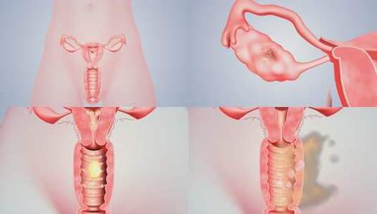 子宫肌瘤  卵巢囊肿  抗衰老 女性健康高清在线视频素材下载