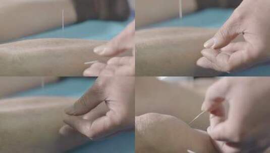 中医院风湿关节痛疼传统针灸扎针经络起针高清在线视频素材下载