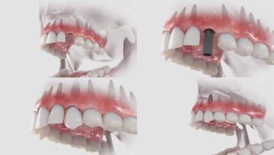 犬牙种植体高清在线视频素材下载