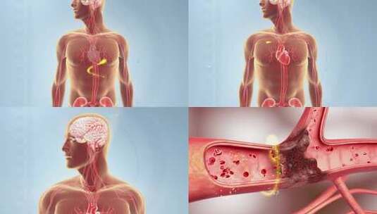 心通 脑通 血管通 心梗 脑梗高清在线视频素材下载