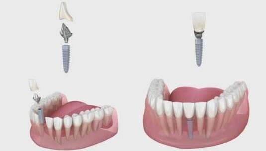 陶瓷冠、定制种植基台和种植体安装工艺。高清在线视频素材下载