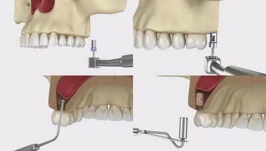鼻窦提升手术与正面通道。牙科手术的3D动高清在线视频素材下载