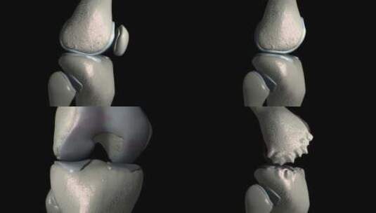 膝关节骨性关节炎伴骨赘高清在线视频素材下载