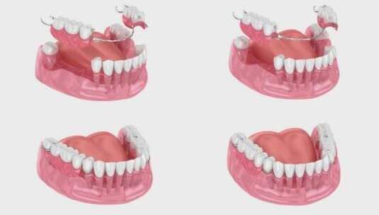 可摘局部义齿，下颌假体。3D动画高清在线视频素材下载