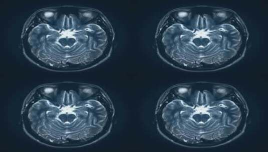 大脑CT扫描动画高清在线视频素材下载