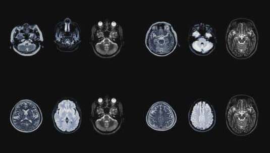 大脑xray扫描动画1高清在线视频素材下载