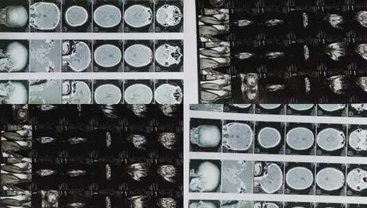 头部x光片人类大脑的磁共振成像MRI高清在线视频素材下载