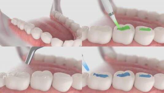 牙科密封剂高清在线视频素材下载