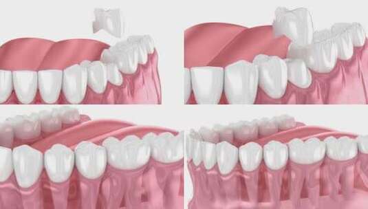 准备好的前磨牙和牙冠放置。牙科3D动画高清在线视频素材下载